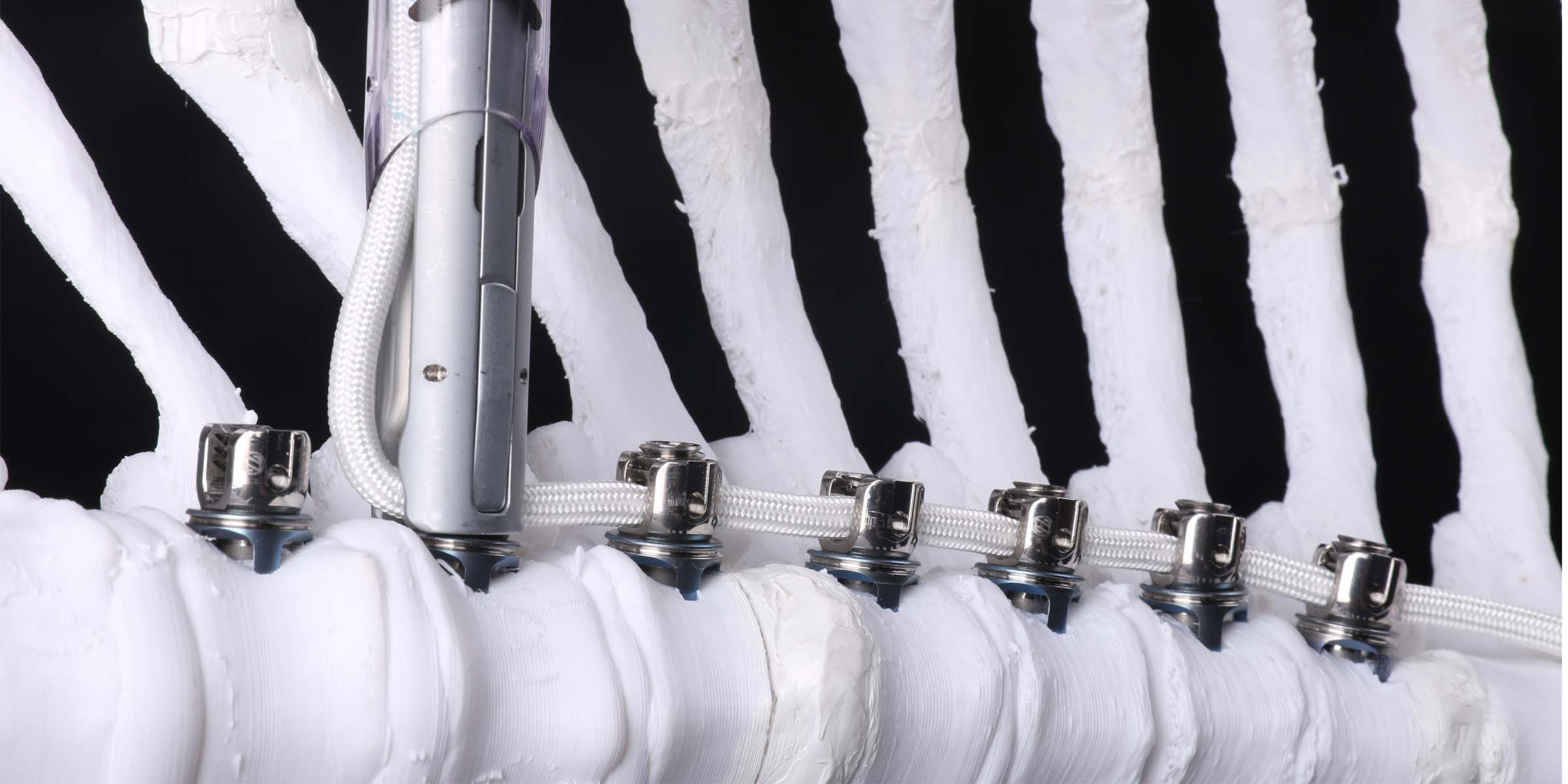 Tether Fusion The Tether fusionless scoliosis device is FDA approved – BIBA Medtech ...